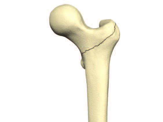 Relative Indications & Contraindications Relative Indications The Omega3 System is indicated for fractures of the proximal femur which may include: Trochanteric fractures and subtrochanteric