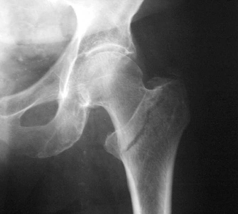 Preoperative Planning Review the frontal and lateral X-Rays of the pelvis and injured femur prior to surgery to assess fracture stability, bone quality, as well as neck-shaft angle and to estimate