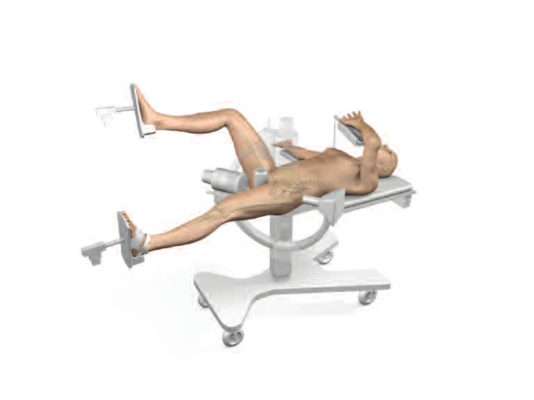 Patient Positioning The patient is placed supine on the fracture table with the hip extended, adducted and slightly rotated inwards, until the patella is in a position parallel to the ground.