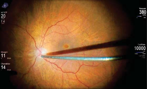 Another feature that digital processing can provide is redshift viewing, which enables the surgeon to view retinal structures through vitreous hemorrhage and avoid delicate structures as the vitreous
