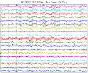 To analyse extensive EEG observations it is necessary to use efficient mathematical tools for extraction of important signal segments. Fig.