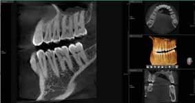 fully covering both maxillary and mandibular structures including the 3rd molar