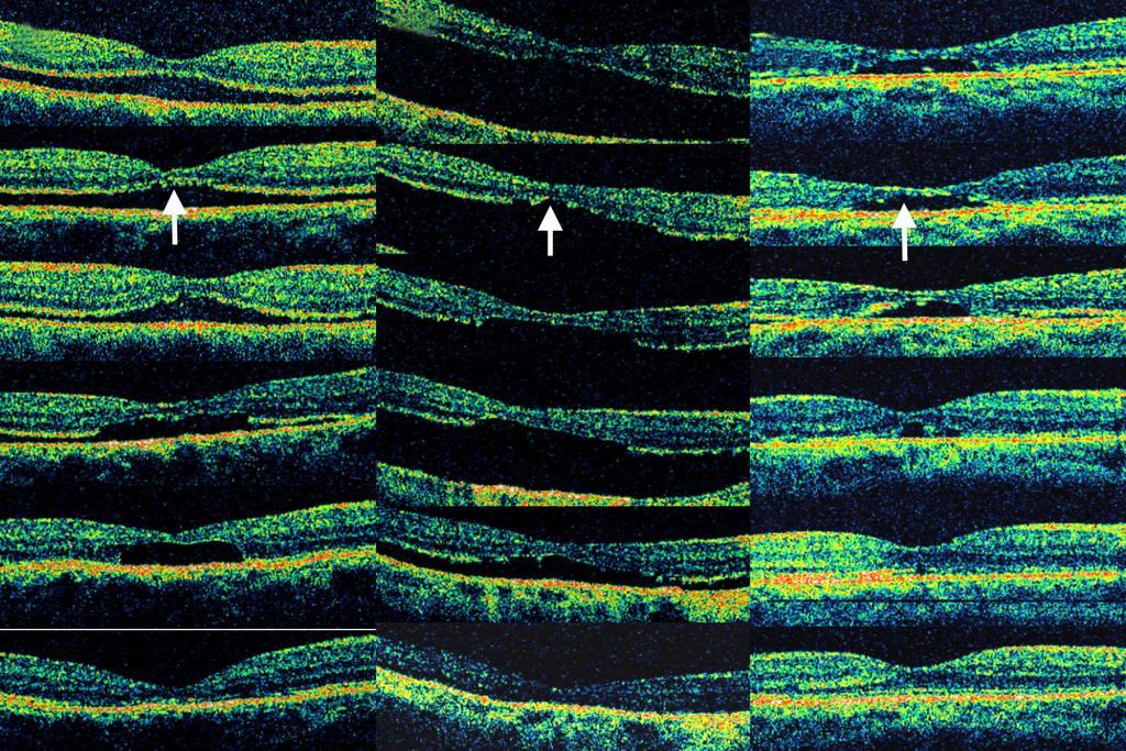 SJ Woo, et al. Photoreceptor Disruption after Scleral Buckling A B C Fig. 2. Optical coherence tomography findings (horizontal scans) of cases 1-3 (A-C).