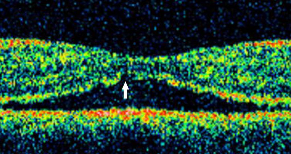 macula-off rhegmatogenous retinal detachment. The error bars indicate 95% confidence intervals of BCVA in the intact photoreceptor group (n = 39).