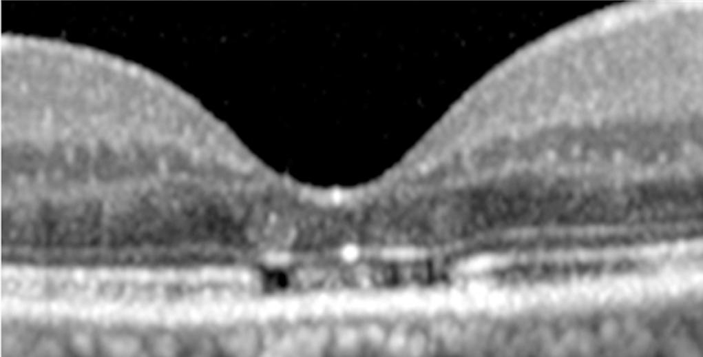 the persistent submacular fluid after retinal detachment surgery was essentially different from the photoreceptor changes in CSC.
