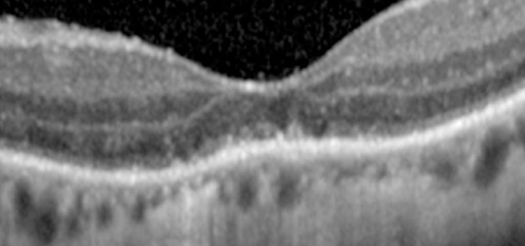 Early signs of progressive photoreceptor disruption (a focal defect in inner and outer segment junction layer) on Stratus OCT (vertical scans) are indicated with arrows in A (case 1) and D (case 2)