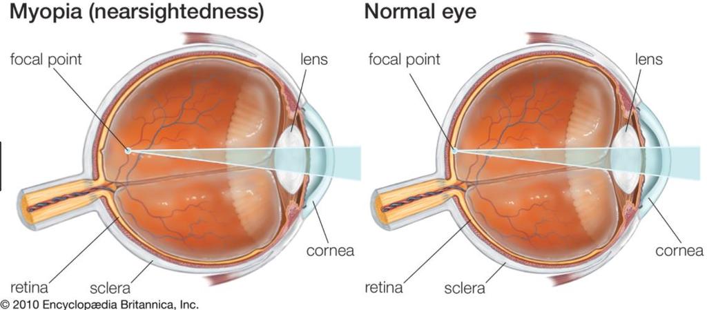 Eye Wish Eye Could See Better For you folks that are nearsighted, the light focuses in front of the retina.
