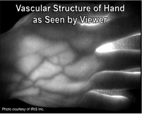 VASCULAR VIEWER TM Vascular Viewer TM reveals blood vessels in the body under a broad range of lighting conditions, allowing medical personnel to access blood vessels more quickly and accurately,