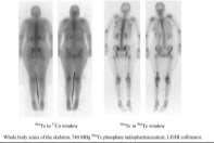 Whole body scan Co57 versus