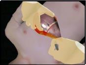 In our system, the surgeon (user) is able to perform various surgical maneuvers with Push Incise Pinch Fig. 1.