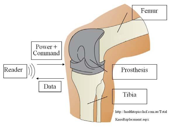 Knee prosthesis monitoring by inductive coupling 10 Goals Increase of the life expectancy of the prostheses Monitoring of the force, movement of the knee and temperature Objectives Transcutaneous