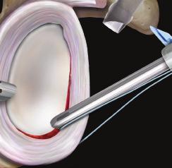3 4 Pass the Spear through the same cannula and place it on the glenoid rim.