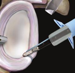 The SwiveLock can be combined with a FiberStick for a very quick and secure labral repair.