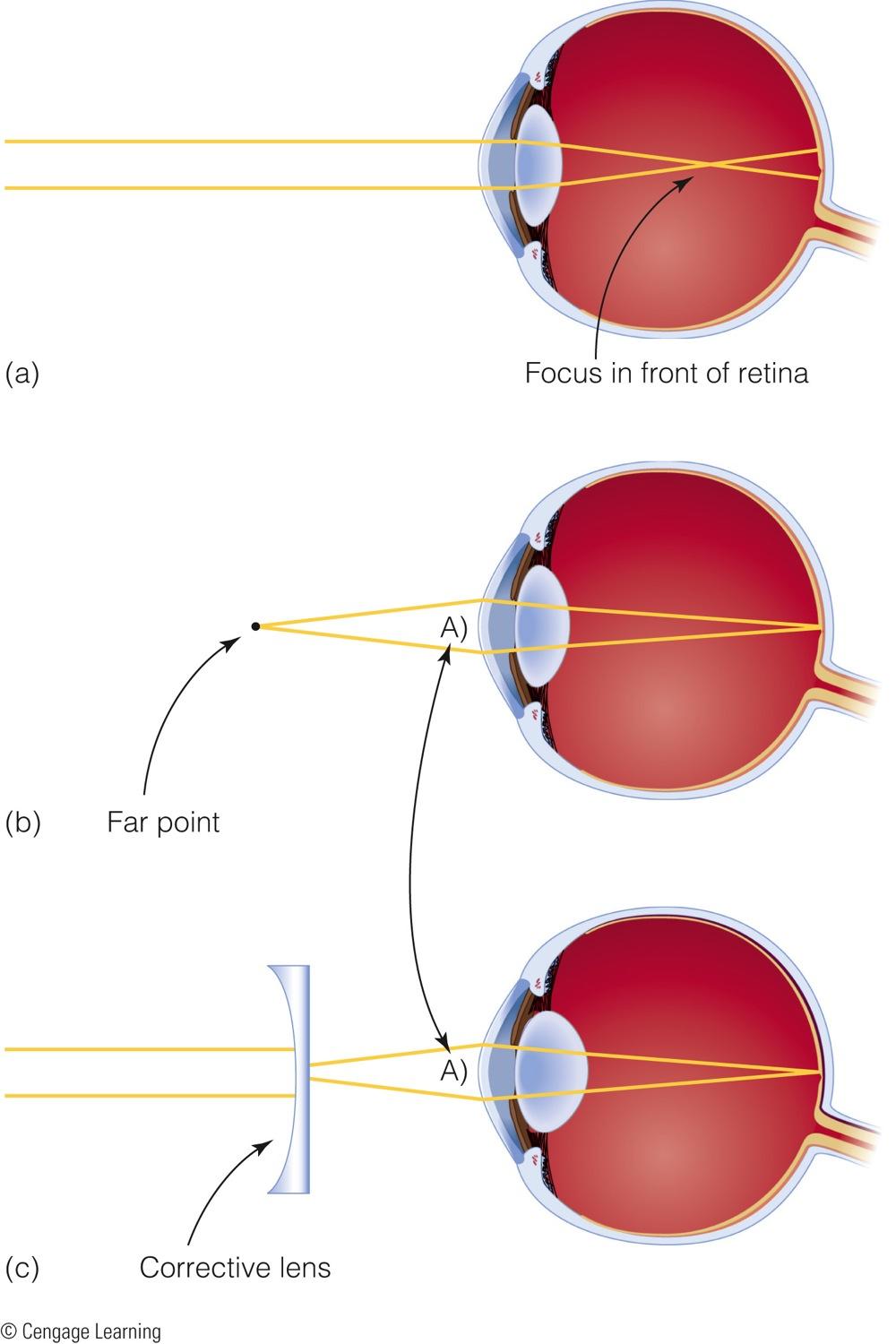 Myopia or nearsightedness - Inability to see distant objects clearly Image is focused in front of retina images of faraway objects are not focused sharply, so objects look blurred.