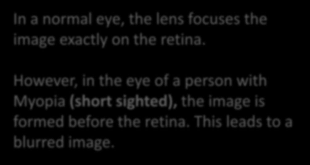 The Eye In a normal eye, the lens focuses the image exactly on the retina. However, in the eye of a person with Myopia (short sighted), the image is formed before the retina.