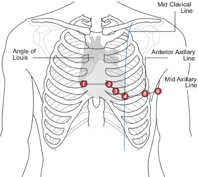 Figure 2.2 Placement of chest leads [25] The electrical impulses that are necessary for the heart to contract originate from the sinoatrial node (SA Node) located above the right atrium.