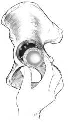 Place the 22mm or 28mm head onto the femoral stem trunion.
