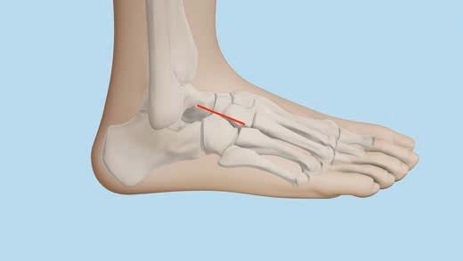 VA Locking Cuboid Plate 1 Approach Make a linear dorsolateral incision starting at the sinus tarsi and extending to the base of the fourth metatarsal.