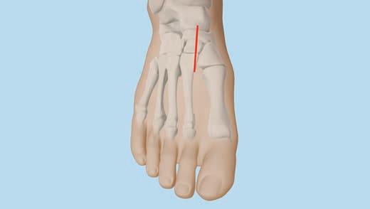 VA Locking Navicular Plate 1 Approach Make a dorsal longitudinal incision from the midneck of the talus towards the base of the second metatarsal.