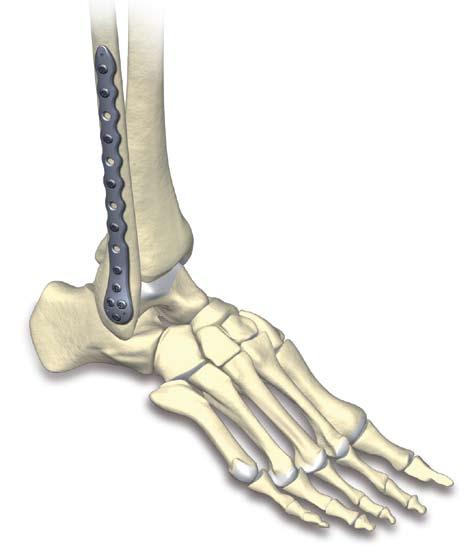 Indications, Precautions & Contraindications Indications The VariAx Distal Lateral Fibula Plate is intended for use in internal fixation of the distal fibula.