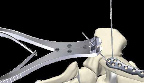 Fluoroscopy can be utilized as needed to confirm position. The plate can then be stabilized by the insertion of K-Wires to ensure anatomical alignment (proximally and distally).