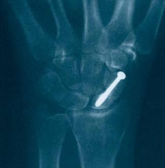 Indications For fracture fixation of small bones and small bone fragments,