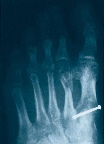 phalanges Osteochondritis dissecans Ligament fixation Fractures of the