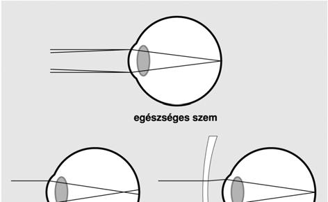 Simplified eye Astigmatism tangential image (focal