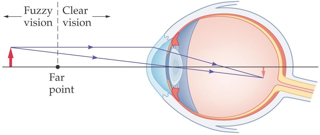 27-2 Lenses in Combination and Corrective Optics A nearsighted person has a far point that is a finite distance away; objects