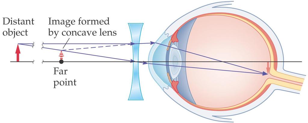 27-2 Lenses in Combination and Corrective Optics To correct this, a diverging lens is