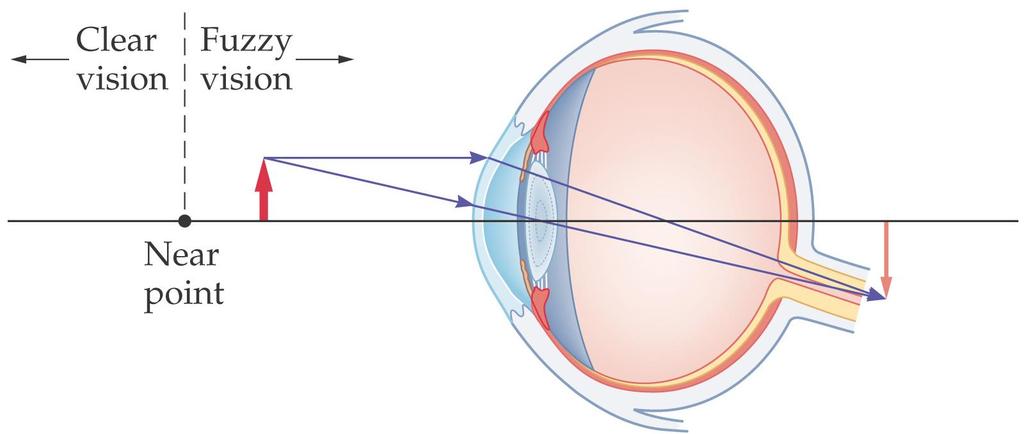 27-2 Lenses in Combination and Corrective Optics A person who is farsighted can see distant objects clearly, but cannot focus on
