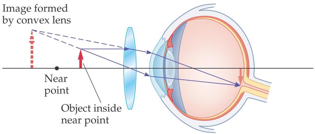 27-2 Lenses in Combination and Corrective Optics To correct farsightedness, a converging