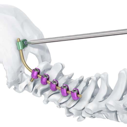 Occipito-Cervical Fixation with Occipital Clamps 8 Insert screw Instruments 388.392 Screwdriver Shaft Stardrive 3.5, T15, self-holding, length 245 mm, for Quick Coupling 324.