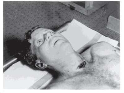 Throat Wound Above - Wound in JFK's Throat.