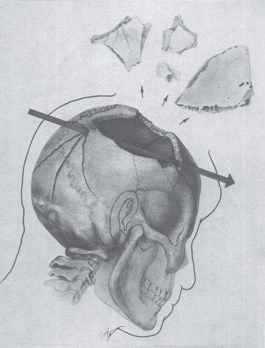Above - Diagram showing the possible trajectory of the missile through JFK's skull.