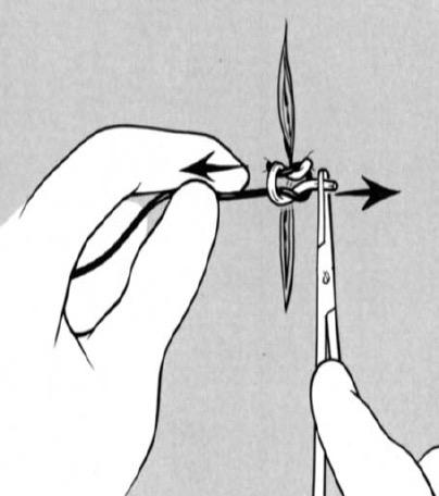 CLAMP SUTURE END AND WITHDRAW IT THROUGH THE SUTURE LOOP TO FORM THE SECOND, SINGLE-WRAP THROW The tips of the needle holder jaws grasp the free suture end and withdraw (arrow) it through the
