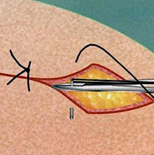 Sutures should be DEEPER than they are WIDE CORRECT will help to create