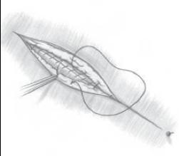 This provides a more secure closure, because if one suture breaks, the remaining sutures will hold the wound edges in