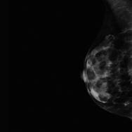 Offering a significant beam hardening when needed, the use of Rhodium increases contrast and visibility of lesions in dense or difficult breasts with optimized level