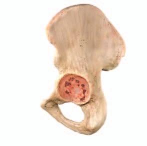 POSSIBLE SURGICAL SOLUTIONS BY DEFECT CLASSIFICATION The Paprosky Classification is the most widely used acetabular defect