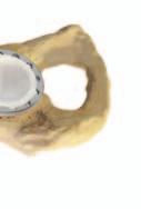 5 Type 1 Anterior/posterior columns are intact and supportive Greater than 70 percent of host bone to hemispherical shell