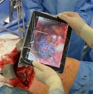 ipad App Aided Tumor Excise An ipad app from Fraunhofer Institute of Medical Image Computing MEVIS Help surgeons excise liver tumors without damaging critical vessels within the organ Tested