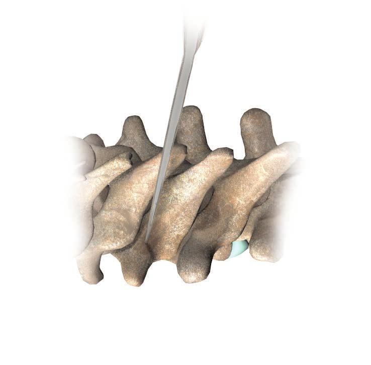 THORACIC OPERATIVE TECHNIQUE 12 Fig. 2b Fig.