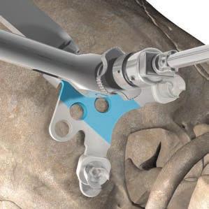tapping or placing bone screws in the occiput.