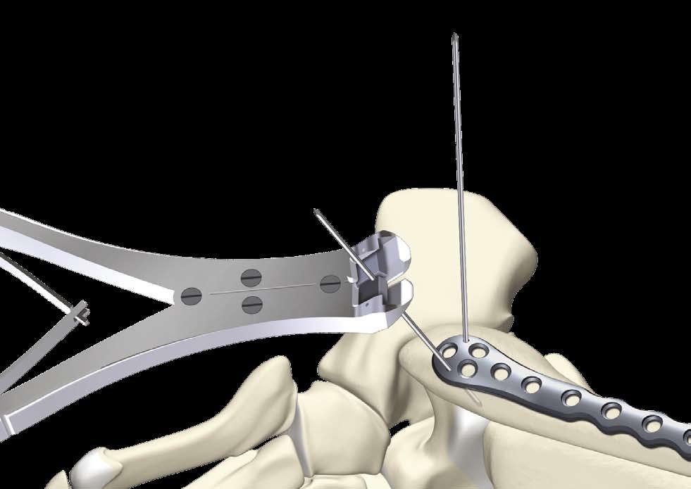Operative Technique Having achieved reduction, the plate is selected and applied to the direct lateral surface of the distal fibula.