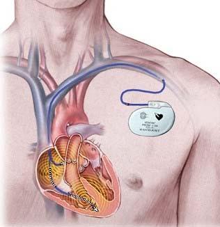 573) RFID Tags Could Affect Pacemakers and ICDs Background: The use of radiofrequency identification (RFID) systems is expanding and highlights the need to address electromagnetic interference (EMI)