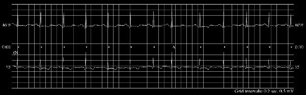One option involves using an algorithm to generate a synthesized ECG signal using Matlab or C.