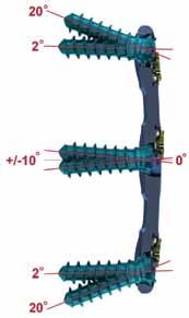 Screw Angulation Cephalad/Caudal Angulation In-situ Variable screws have a wide range of variability in their degree of cephalad/ caudal orientation.