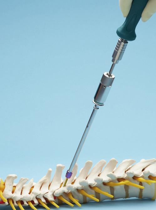 Surgical Technique 6 Insert screw Instruments 03.614.017 Holding Sleeve with thread 03.614.036 Outer Sleeve for Holding Sleeve No. 03.614.017 03.614.039 Hexagonal Screwdriver Shaft, cross pinned 324.