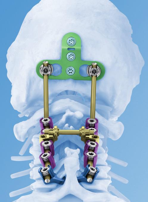Synapse is fully compatible with the Occipito-Cervical Fusion system for posterior occipito-cervical fixations The Synthes